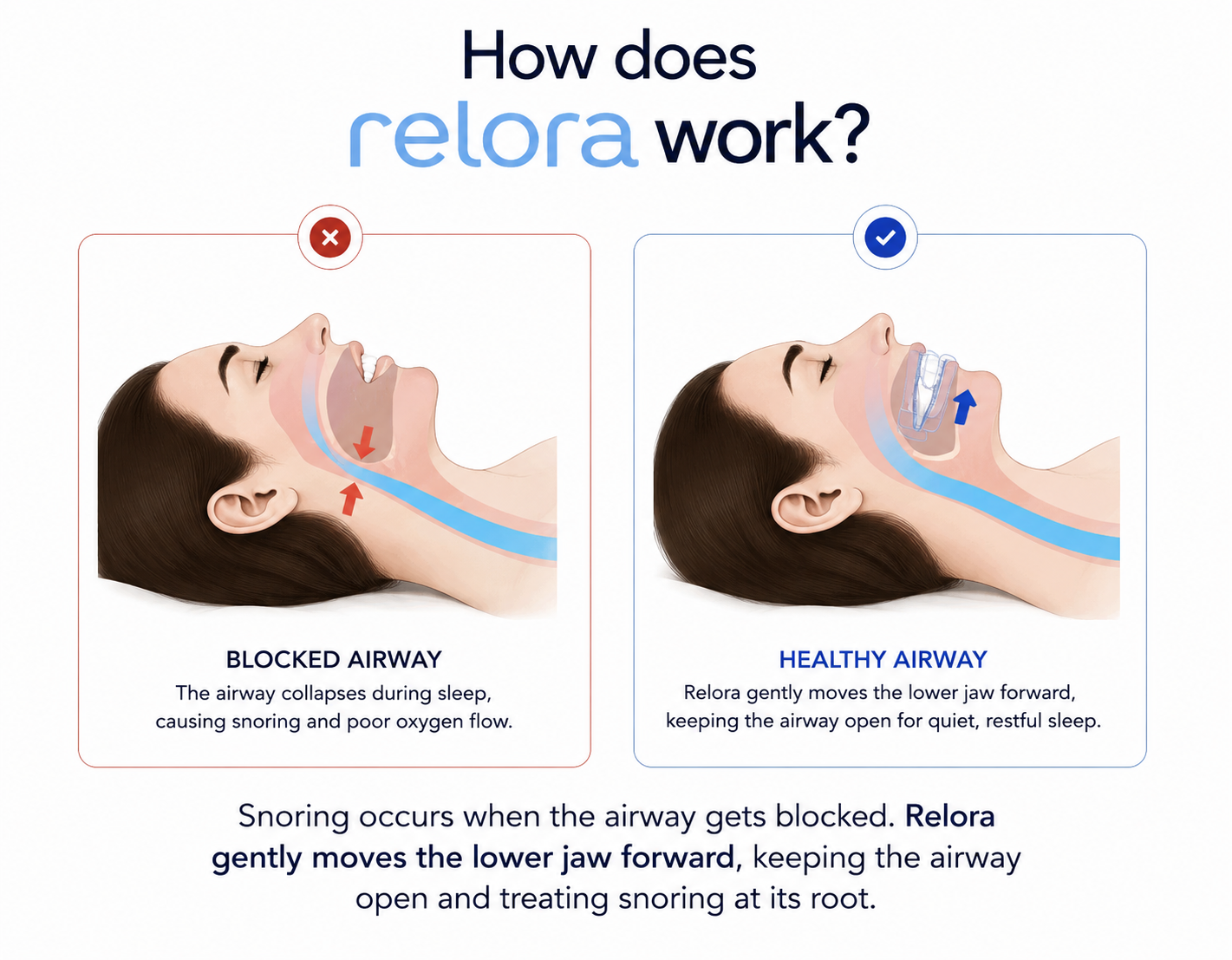 Relora Precision Adjustable Sleep & Snore Guard
